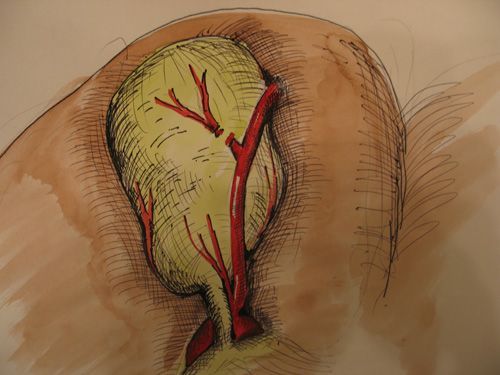 Аномальный артериальный сосуд у стенки желчного пузыря