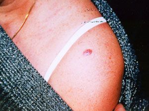 Лечение и диагностика базально-клеточного рака кожи