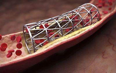 Ангиопластика и стентирование артерий