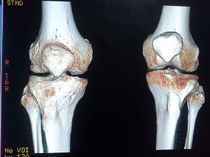 Компьютерная томография коленного сустава