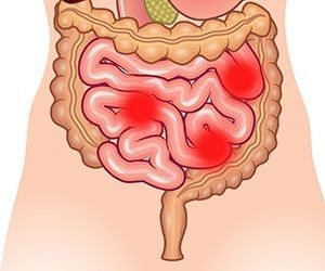 Эндоскопическая полипэктомия кишечника и желудка