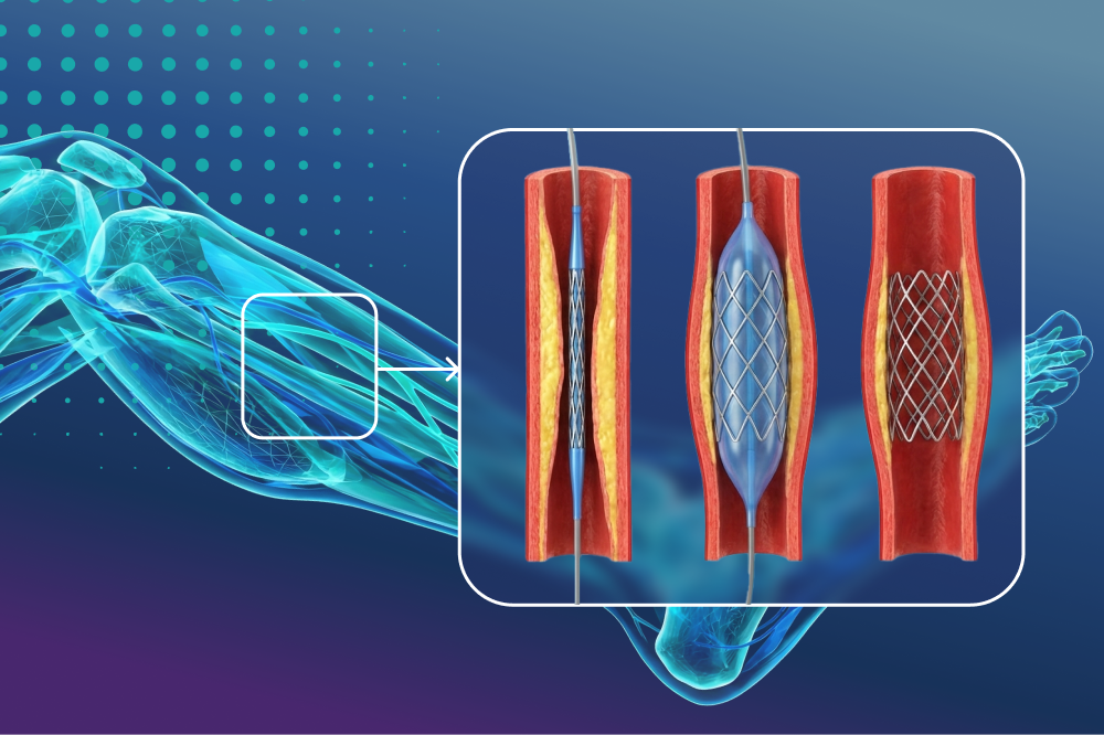 Стентирование артерий нижних конечностей со скидкой 40%