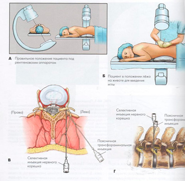 Выполнение селективной и трансфораминальной блокады корешка спинномозгового нерва»