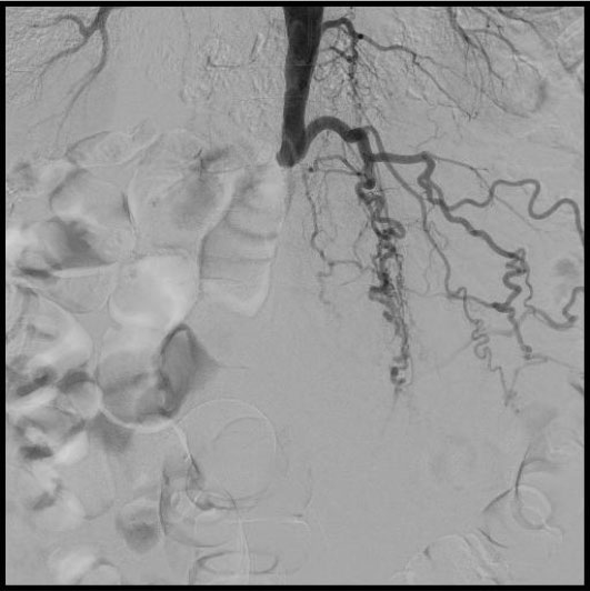 Окклюзия аорты, клиника ЦЭЛТ