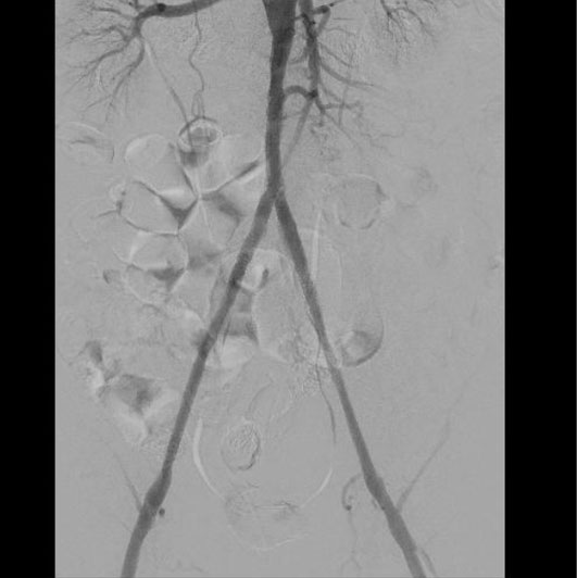Восстановленный нормальный кровоток, клиника ЦЭЛТ