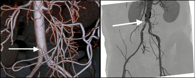 МСКТ 3-D реконструкция брюшной аорты и периферических артерий. Справа: стеноз верхней мезентериальной артерии (стрелка). Слева: окклюзия правой подвздошной артерии (стрелка)