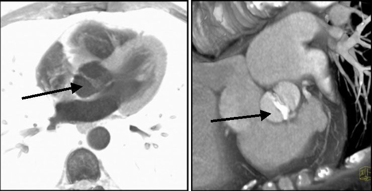Слева - бикуспидальный аортальный клапан (стрелка)