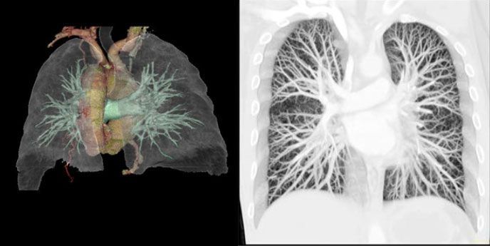 МСКТ визуализация сердца, легких, легочных вен и артерий.