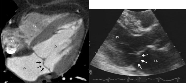 МСКТ сердца по длинной оси (рис. слева) и ЭХОКГ по длинной оси в парастернальной позиции (рис справа). LA-левое предсердие; LV-левый желудочек; RA-правое предсердие; RV-правый желудочек. Пролапс задней створки митрального клапана (стрелки)