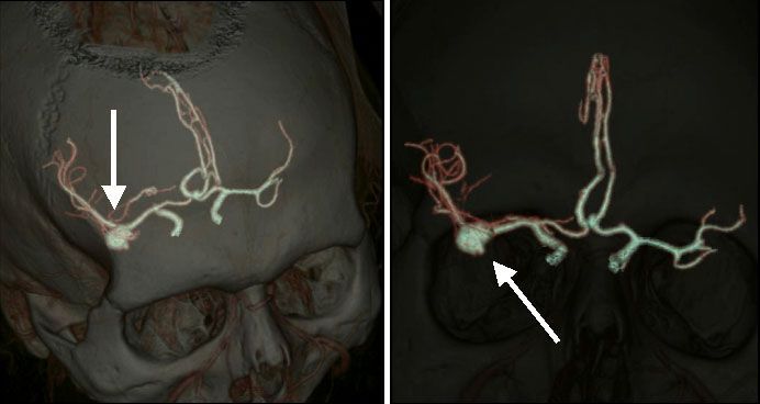 Диагностированная аневризма артерии при  МСКТ интракраниальных артерий (стрелки)