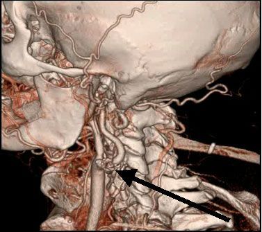 МСКТ 3-D реконструкция сонных артерий. Стеноз левой внутренней сонной артерии (стрелка)