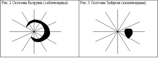 нормальные размеры слепого пятна