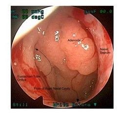 Увеличенные аденоиды. Эндоскопическая картина
