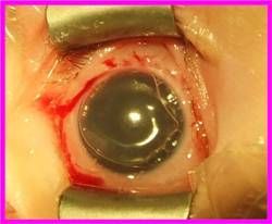 Хирургическое лечение сочетанной глазной патологии у детей с синдромом Lowe