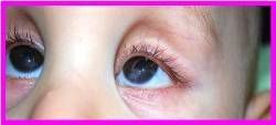 Хирургическое лечение сочетанной глазной патологии у детей с синдромом Lowe