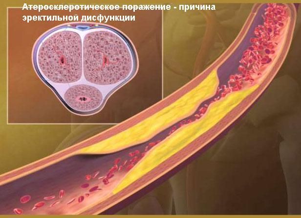 Атеросклеротическое поражение - причина эректильной дисфункции