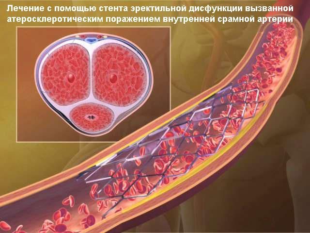 Лечение эректильной дисфункции