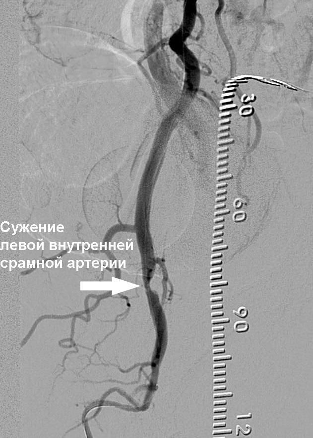 Сужение левой внутренней срамной артерий