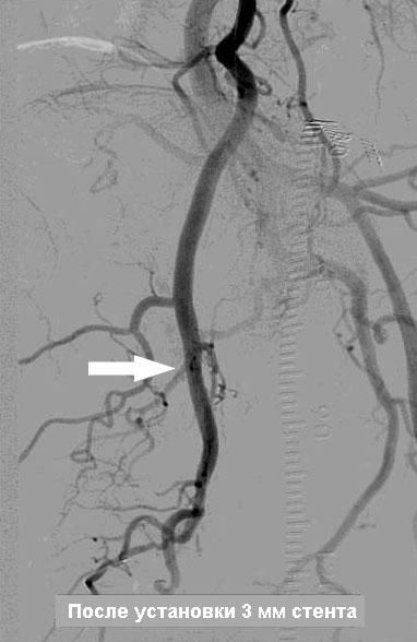 Установка 3мм стента