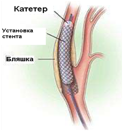 Стентирование сонных артерий