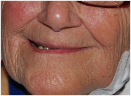 Повреждение черепных нервов после КЭЭ слева (опущение угла рта, сглаженность носогубной складки, парез мимической мускулатуры)