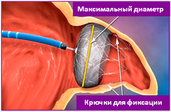 Мерцательная аритмия