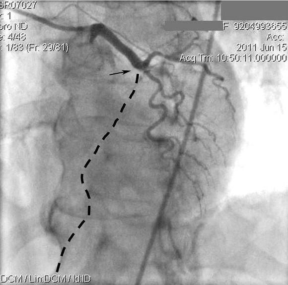 Артерии сердца после диагностического исследования