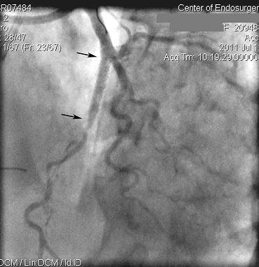 Артерии сердца пациентки, которой предлагали операцию аорто-коронарного шунтирования