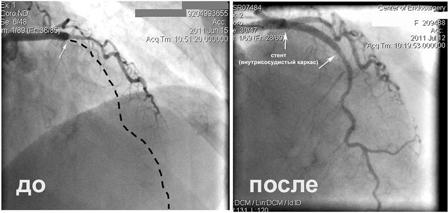 Артерии сердца пациентки, которой предлагали операцию аорто-коронарного шунтирования.