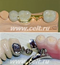 Применение замковых креплений в бюгельных протезах при замещении концевых и включенных зубных дефектах