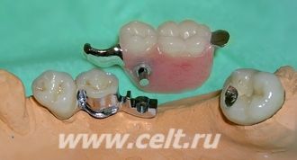 Односторонний бюгельный протез со скрытым замком МК-1 Односторонний бюгельный протез со скрытым замком МК-1