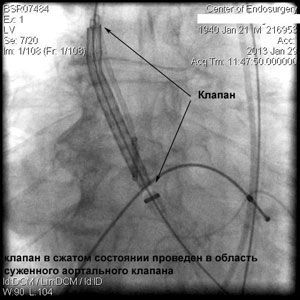 Имплантация аортального клапана