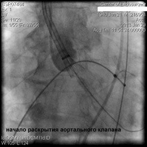 Имплантация аортального клапана