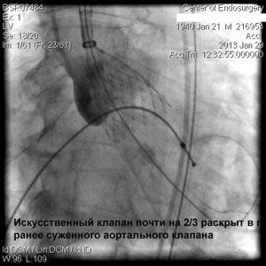 Имплантация аортального клапана