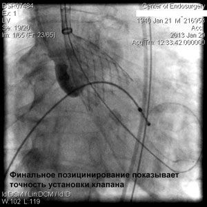 Имплантация аортального клапана