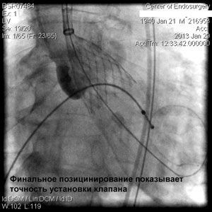 Вальвулопластика аортального клапана