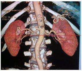 МСКТ почечных артерий