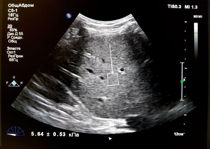 Так выглядит на эластографии здоровая печень