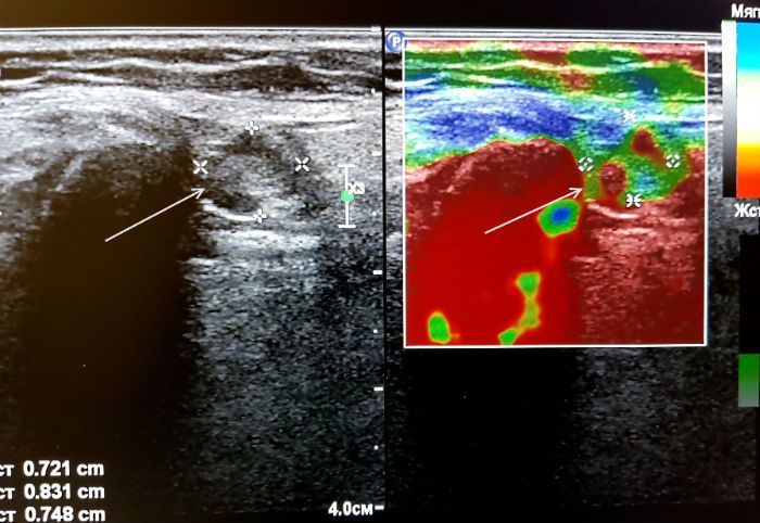 Эластография щитовидной железы что это. Компрессионная эластография печени. Эластография лимфатических узлов. Эластография щитовидной железы что это такое. Компрессионная эластография молочных желез.