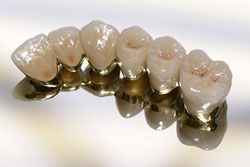 Керамические коронки при протезировании зубов