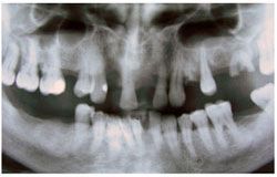 Состояние зубов при пародонтозе.