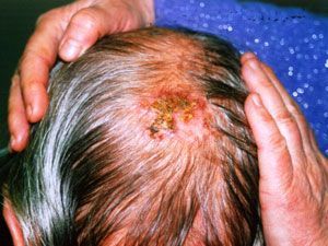 Лечение и диагностика базально-клеточного рака кожи