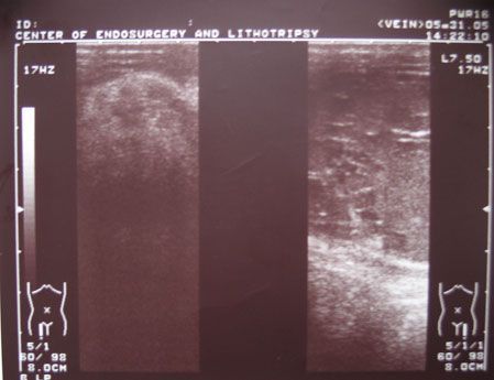Картина УЗИ у больного с гематомами паховых каналов