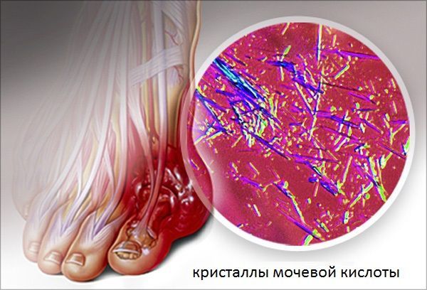 Подагра современный взгляд на болезнь. Что нужно знать о подагре?