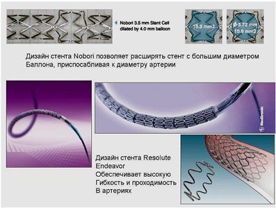 Стенты 2-го поколения