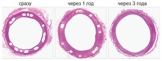 Биоабсорбируемые стенты ABSORB