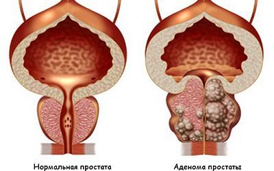 2. fokozatú prosztata adenoma hogyan kezelik a prosztatát