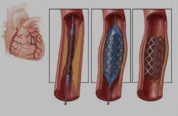 Ангиопластика и стентирование артерий