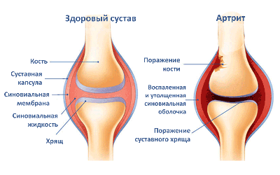 Артрит