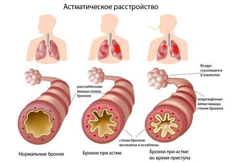 астматическое расстройство